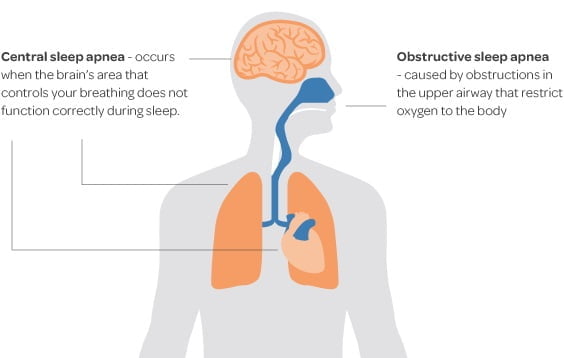 Ultimate Guide – Everything You Need to Know About Sleep Apnea