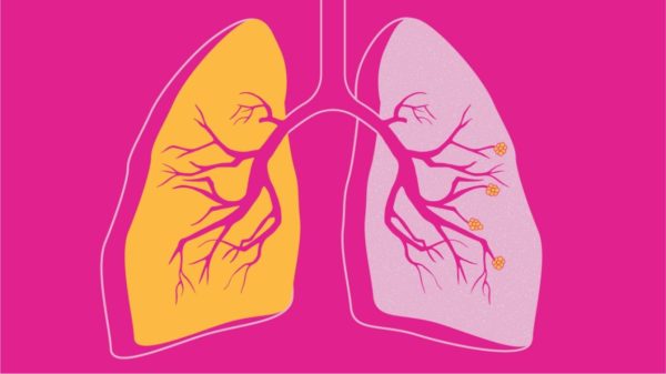 COVID-19 and COPD Patients